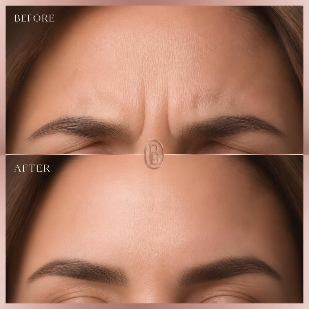 Before and after Botox glabellar frown lines